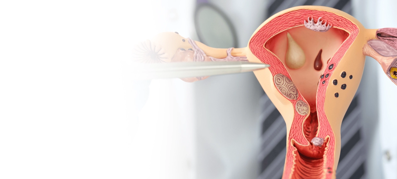 Gynecologic Cancer: Types, Symptoms, and Treatment Guide